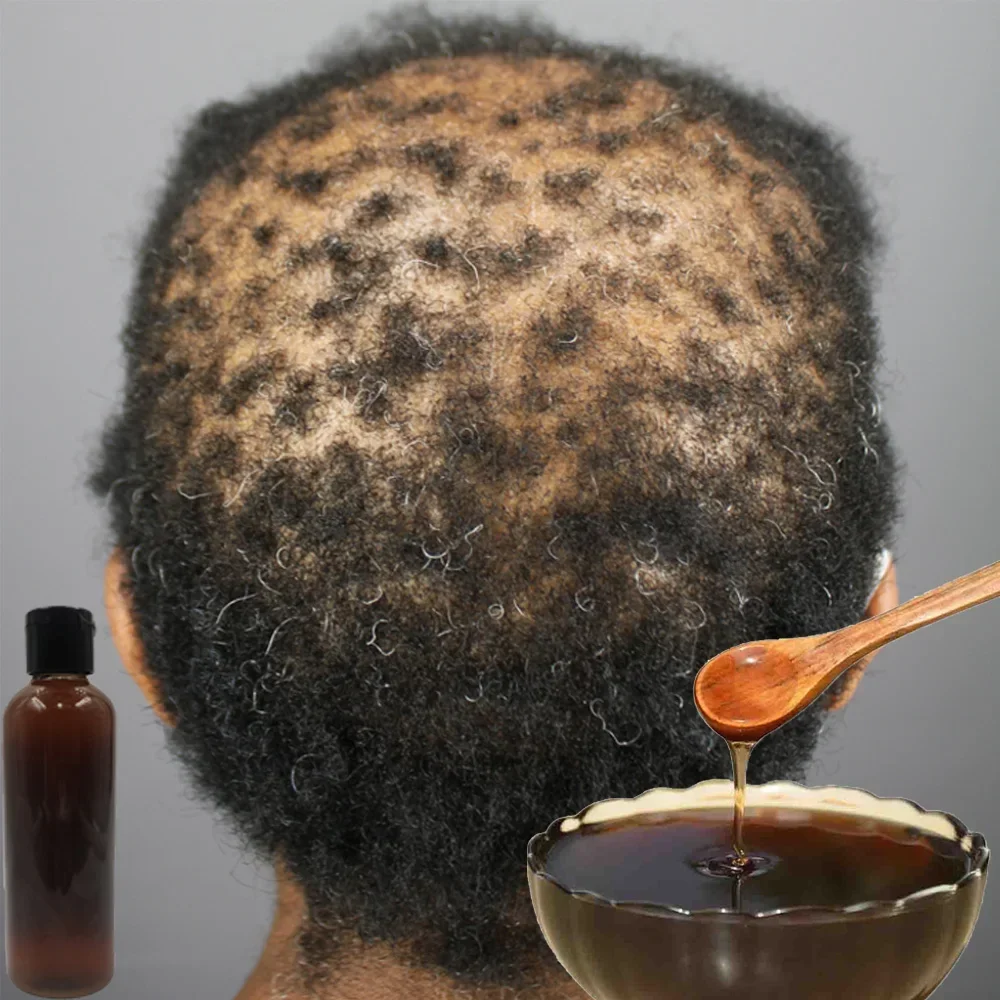 Africa Women Traction Alopecia - Hair Care Ginseng のレビューと価格